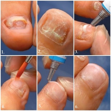 hogyan lehet lágyítani a körmöket körömgombával modern hatékony gyógymód körömgomba ellen